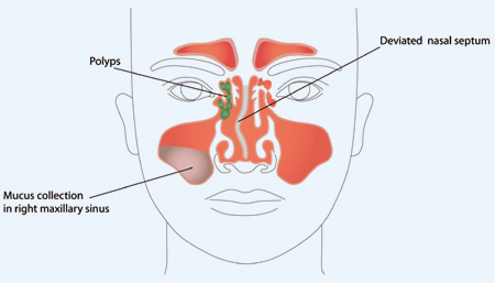 polyps